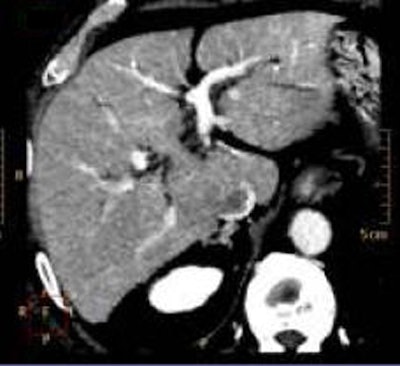In a CT image of the liver produced by first-generation iterative reconstruction, image shows blotchiness centrally in the liver caused by the shift in noise distribution at low frequency levels, and edge enhancement caused by the shift in image noise at high frequency levels. All images courtesy of Dr. Jeffrey Mendel.