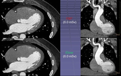 Ultralow-dose CT acquisition in bariatric patient with iDose shows high level of detail in the heart, including detail in the mitral valve and endocardial surface (bottom) that is lost on FBP images, top.