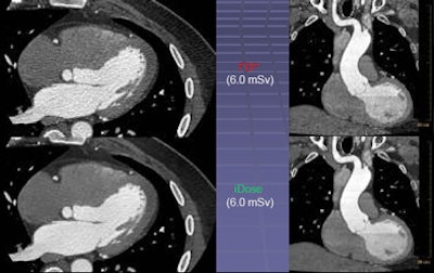 Ultralow-dose CT acquisition in bariatric patient with iDose shows high level of detail in the heart, including detail in the mitral valve and endocardial surface (bottom) that is lost on FBP images, top.