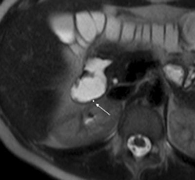 2010 08 31 13 38 55 760 Celiac Untreated A 250