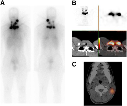SPECT/CT for thyroid cancer helps avoid more imaging tests | AuntMinnie