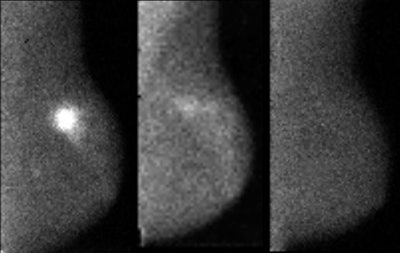Advances In Molecular Breast Imaging Special Report, Aunt Minniecom: Treatment Response Of Patient With Stage Ii Invasive Ductal Carcinoma