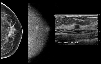 Advances In Molecular Breast Imaging Special Report, Aunt Minniecom: Images Show (l To R) Negative Mammogram (craniocaudal View), Mbi Study (craniocaudal View), And Ultrasound Study