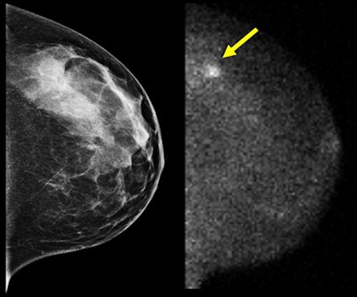 Advances In Molecular Breast Imaging Special Report, Aunt Minniecom: 45 Year Old Woman With Dense Breasts Screening Mammogram (l), Mbi (r)
