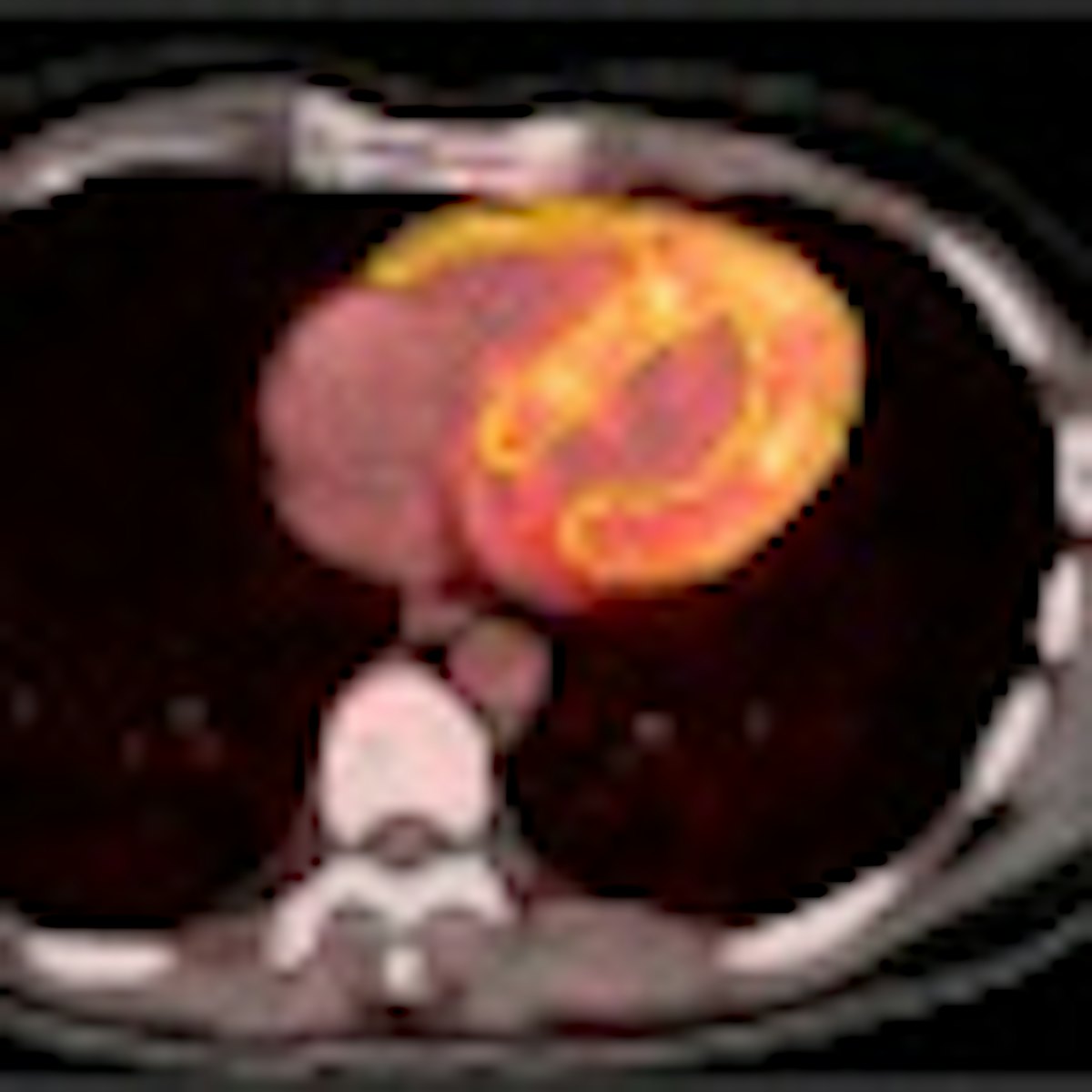 Study updates dose estimates for rubidium-82 cardiac PET | AuntMinnie