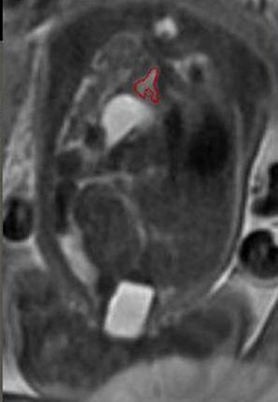 2010 10 06 15 36 28 829 Lee leftlungtop V2