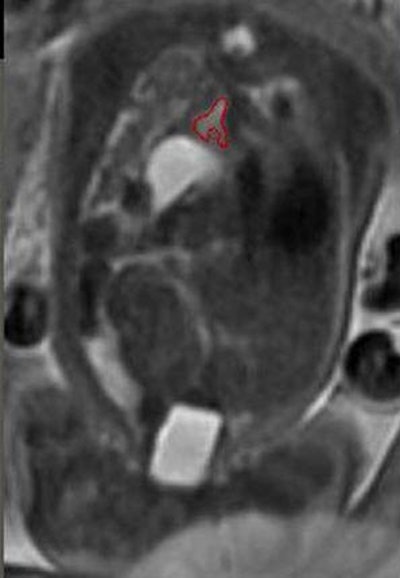 2010 10 06 15 36 28 829 Lee leftlungtop V2