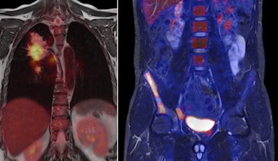 2010 11 18 17 37 26 910 Lung Sceleton Combined 450