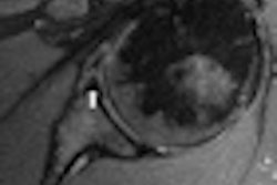 2010 11 30 17 51 16 925 Shoulder Left Thumb