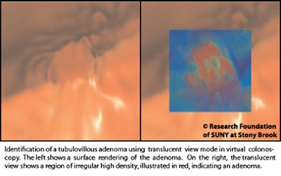 2010 12 06 11 44 44 100 Marino tubulovillous