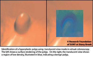 2010 12 06 11 44 51 523 Marino hyperplastic