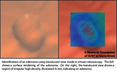 2010 12 06 11 44 53 377 Marino adenoma