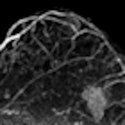 2010 12 21 13 59 53 207 Martincich Mri Breast Thumb