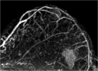 2010 12 21 13 59 54 854 Martincich Mri Breast 394