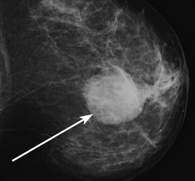 2011 01 05 16 16 57 827 Woods Mammo Fig3 394