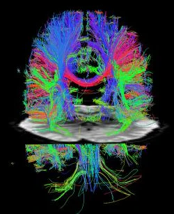 Advance in MRI allows faster brain scans | AuntMinnie