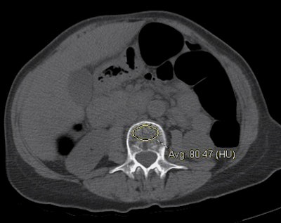 2011 01 19 16 07 39 444 Pickhardt osteoporosis bottom