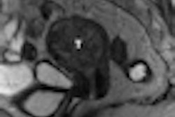 2011 01 25 16 06 09 599 Mri Uterine 01 Thumb