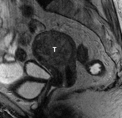 2011 01 25 16 06 11 509 Mri Uterine 01 394