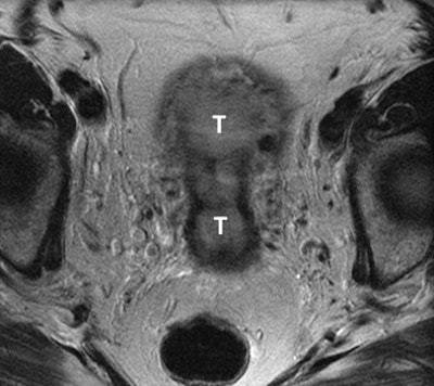 2011 01 25 16 06 13 516 Mri Cervix 02 394