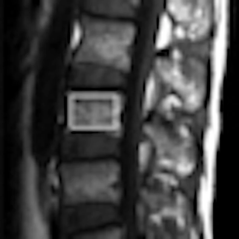Dynamic Mri Dynamic MRI predicts outcomes for myeloid leukemia patients | AuntMinnie