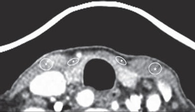 2011 02 28 13 11 10 255 Lee thyroid 02 Right