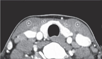 2011 02 28 13 11 10 296 Lee thyroid 02 Left 394