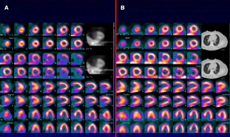 Hardware, software advances spark cardiac SPECT progress | AuntMinnie