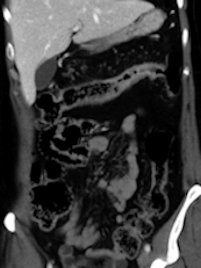 Left: Elderly patient presenting with low-grade bowel obstruction. Optical colonoscopy was denied due to patient's condition, and a CT with water enema was performed in order to detect a large lesion. This was the case because the patient had an almost occlusive cancer of the sigmoid. Right: Crohn's disease involving the transverse colon, with wall thickening and hyperhemia of the colonic vessels. All images courtesy of Dr. Yves Menu.