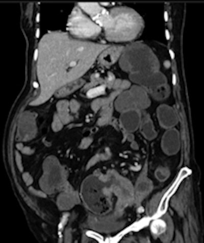 2011 03 02 14 07 59 181 2011 03 04 Cancer Sigmoid