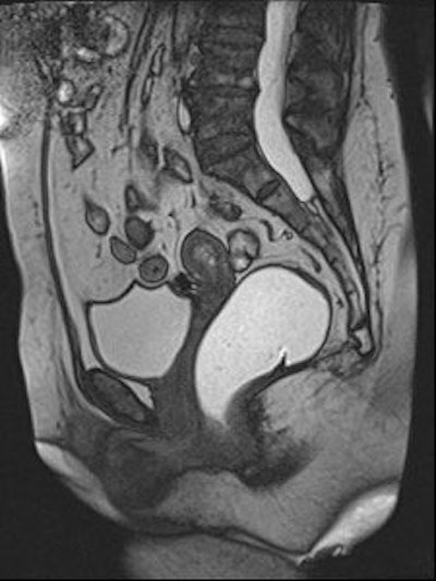 2011 03 02 23 45 44 913 2011 03 04 Pelvic Rectocele Rest