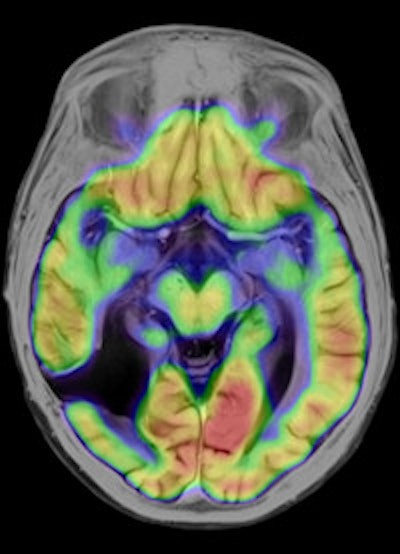 Left: To improve the precision of spatial registration, the Biograph mMR system collects MR and PET data simultaneously from a single frame of reference. The result is a combined MR and PET scan acquired at the same point in time and reflecting the same point in the physiologic processes such as respiration. Right: The benefits of MRI in the study of neurological diseases are well-known and established, and it can lead to a better understanding of neurological pathologies. Images courtesy of Siemens.