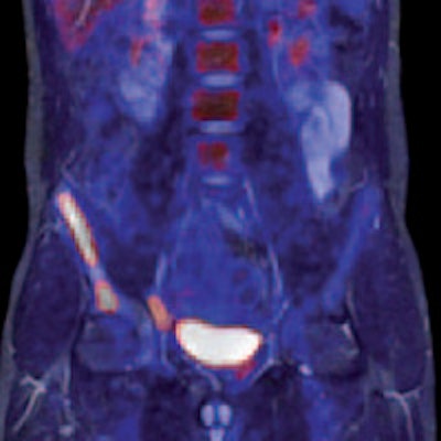 Left: PET tracer uptake in the liver can be combined with the time-varying enhancement of dynamic MR scans to visualize hepatic tumor characteristics. Right: MR and PET come together to support tumor staging. In this case, high-resolution MR provides a clear image of the pathology within the pelvic structure, while PET displays the hypermetabolism component of the lesion. Images courtesy of Siemens.