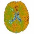 2011 03 06 15 03 09 727 2011 03 07 Brain Perfusion Thumb