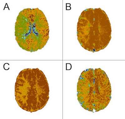 2011 03 06 15 03 11 786 2011 03 07 Brain Perfusion Four