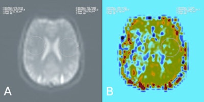 These six images show a comparison between contrast-enhanced perfusion and non-contrast perfusion using arterial spin labeling technique in a 34-year-old male with a chronic obliteration of the right middle cerebral artery. In the set of four contrast-enhanced perfusion images, A = time-to-peak (TTP), B = relative cerebral blood volume (CBV), C = relative mean transit time (MTT), D = relative cerebral blood flow (CBF). The other two are pulsed arterial spin labeling (QUIPPS II sequence) images. A: Sample of source data, signal in the circular region placed in the left hemisphere is 102% of that in the right. B: Relative cerebral blood flow, signal in the circular region placed in the left hemisphere is 271% of that in the right. Image courtesy of Dr. Josef Vymazal.