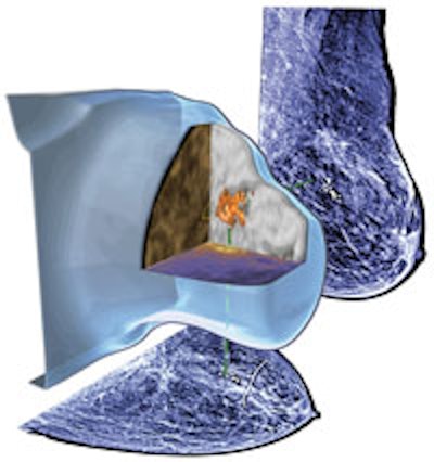 Combined aspects of multimodality breast imaging and diagnosis in HAMAM. Registered multimodal images (MRI, ultrasound, and PEM) of the segmented lesion representing different physical and biological properties. They are visualized together with a correlated view of the breast MRI volume and the mammographic projections.