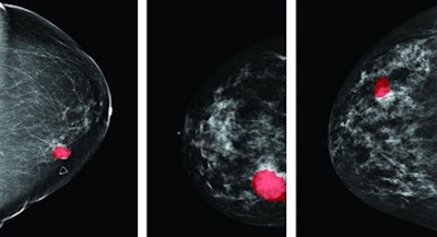 Completeness of breast surface map for the three scanning positions.
