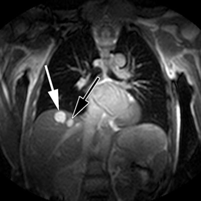 Benign noncardiac findings