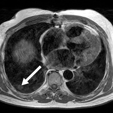 Lung nodule on T1-weighted image