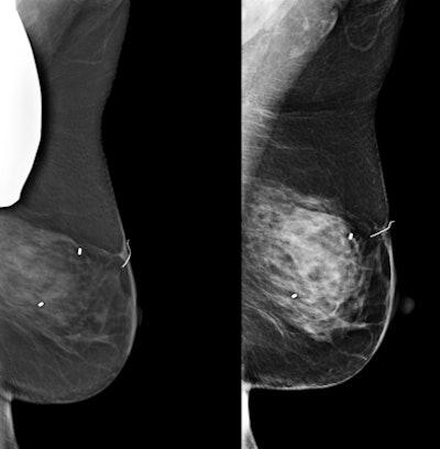 Images from a patient who underwent mammography with a thyroid shield. The image on the left is a mediolateral oblique view demonstrating the thyroid shield obscuring the upper posterior breast along with a degraded image. The image on the right was repeated without the shield and shows normal breast tissue. All images courtesy of Dr. Phil Evans.