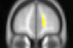 2011 04 22 14 11 09 502 Ocd Mri Image B Thumb