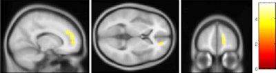 2011 04 22 14 11 10 240 Ocd Mri Image B 450