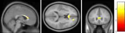2011 04 22 14 11 11 366 Ocd Mri Image A 450