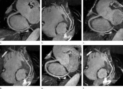 2011 05 05 16 47 12 801 Mra With Coils 450