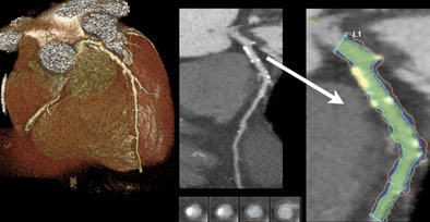 2011 05 17 15 58 08 575 Otton calciumscoring top