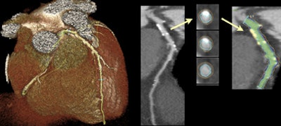 2011 05 17 15 58 11 102 Otton calciumscoring bottom