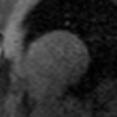 First-pass MRI perfusion immediately following maximum treadmill exercise stress. Image indicates prominence of septal perfusion defect induced by exercise stress. Image courtesy of Orlando Simonetti, PhD.