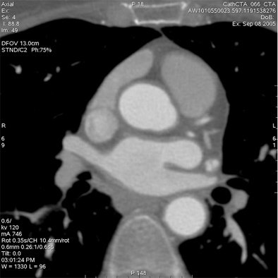 Which image would you rather be responsible for? Small 13-cm FOV (above) provides the best cardiac image quality at the lowest radiation dose compared with medium 25-cm FOV coronary CTA image (below). Thoracic image (bottom) maximizes anatomic coverage but at the cost of additional radiation and potentially more incidental findings. All images courtesy of Dr. Matthew Budoff.