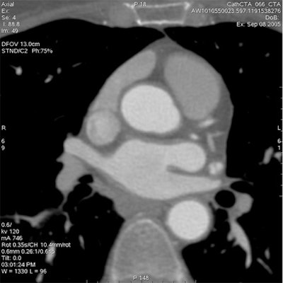 Which image would you rather be responsible for? Small 13-cm FOV (above) provides the best cardiac image quality at the lowest radiation dose compared with medium 25-cm FOV coronary CTA image (below). Thoracic image (bottom) maximizes anatomic coverage but at the cost of additional radiation and potentially more incidental findings. All images courtesy of Dr. Matthew Budoff.